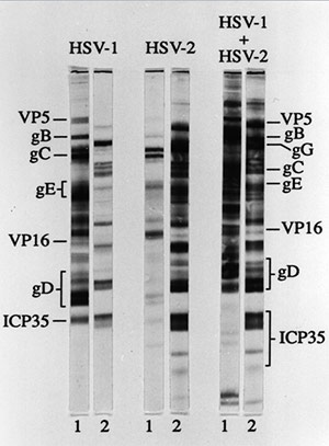 The paired samples show positive results of the Western Blot for HSV-1 (first pair), HSV-2 (second pair) and both HSV-1 and HSV-2 (third pair). VP5, gB, etc. are HSV proteins to which antibody was detected.