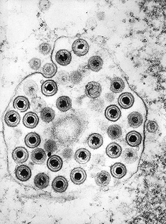 electron microscope image of herpes simplex viruses