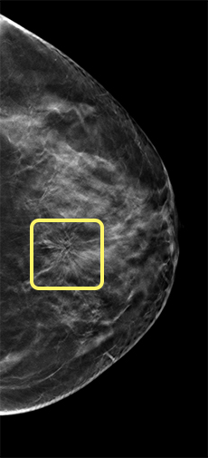 3D mammogram slice in the craniocaudal projection that shows an area of architectural distortion suggestive of malignancy
