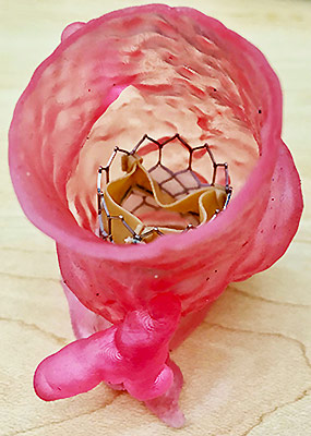 3D-printed model of a patient'