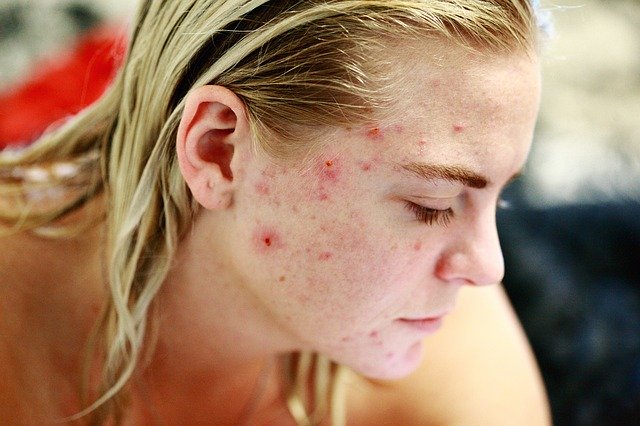 picture of woman with acne on face