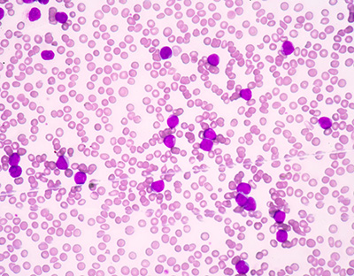blood smear from AML patient