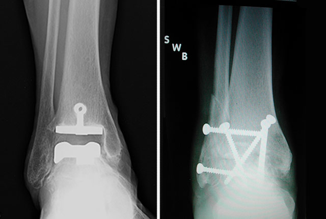 Ankle Fusion - Ankle - Surgery - What We Treat 