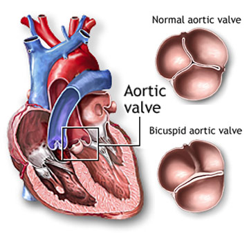 illustration of bicuspid and tricuspid aortic valves