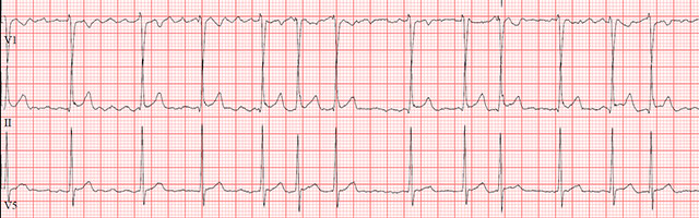 electrocardiogram strip