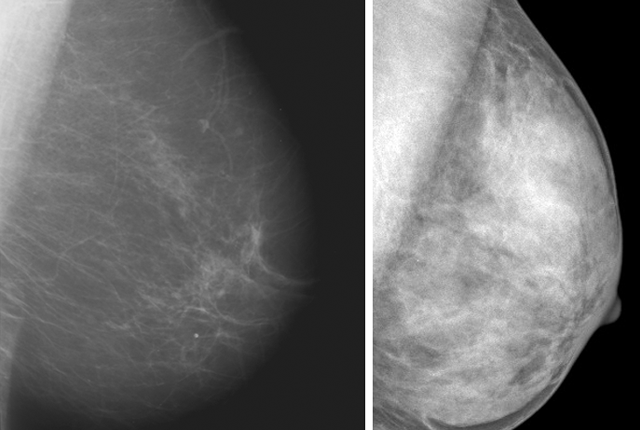 FDA aims to level field on breast-density disclosure to patients