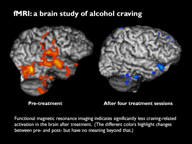 before and after alcohol brain