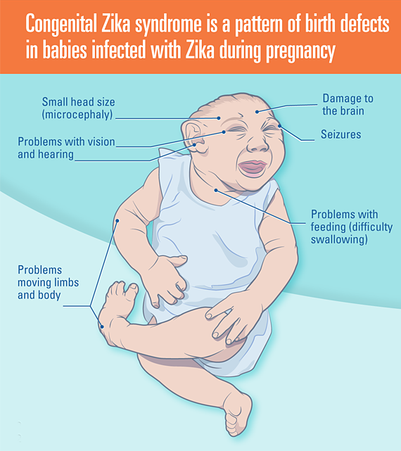 illustration of Zika virus effects on a child