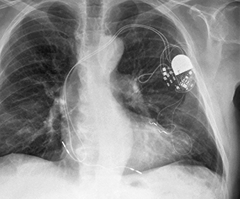 radiology scan showing conventional pacemaker