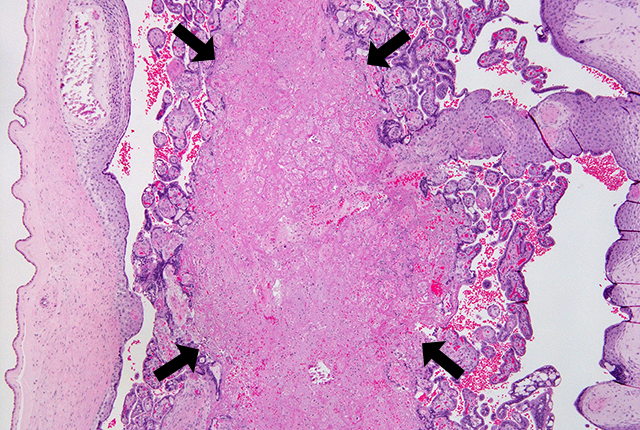 picture of placental tissue affected by flu