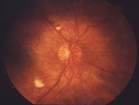 scan showing proliferative diabetic retinopathy