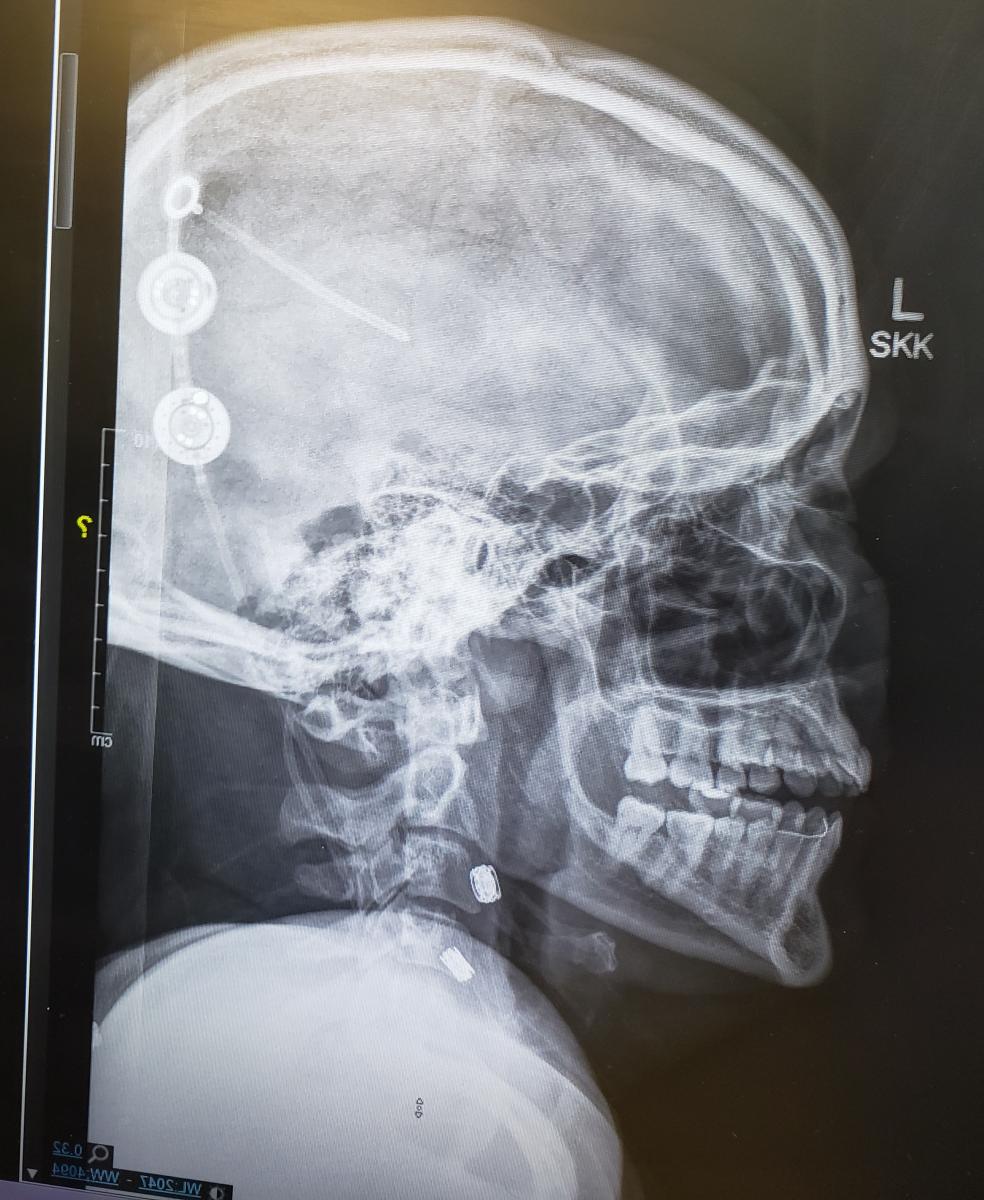X-ray of hydrocephalus shunt in position in the skull