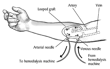 illustration of arteriovenous graft