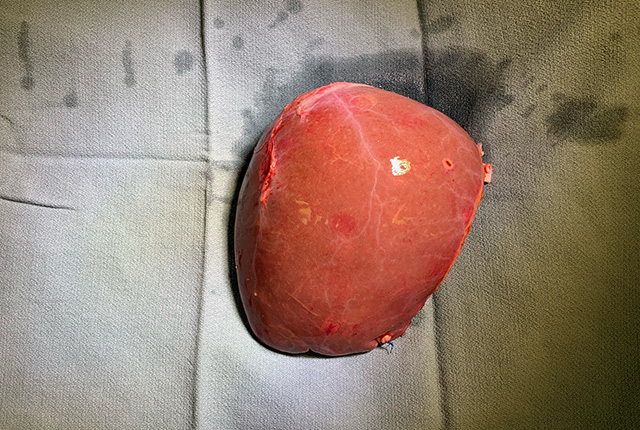 Drs. Mark Sturdevant and Ramasamy Bakthavatsalam prepare a lobe of liver for transplant