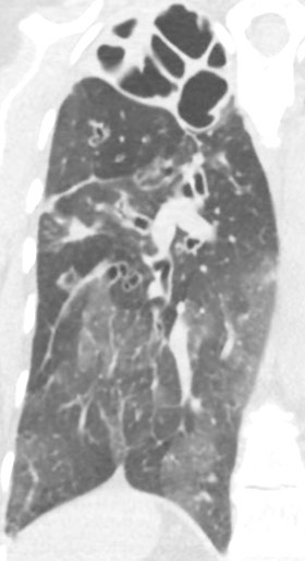 x-ray of lung infected with pseudomonas bacteria