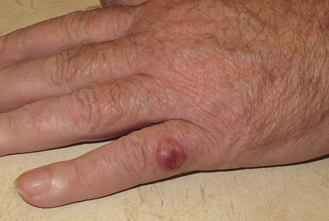 picture of Merkel cell cancer lesion on patient’s hand