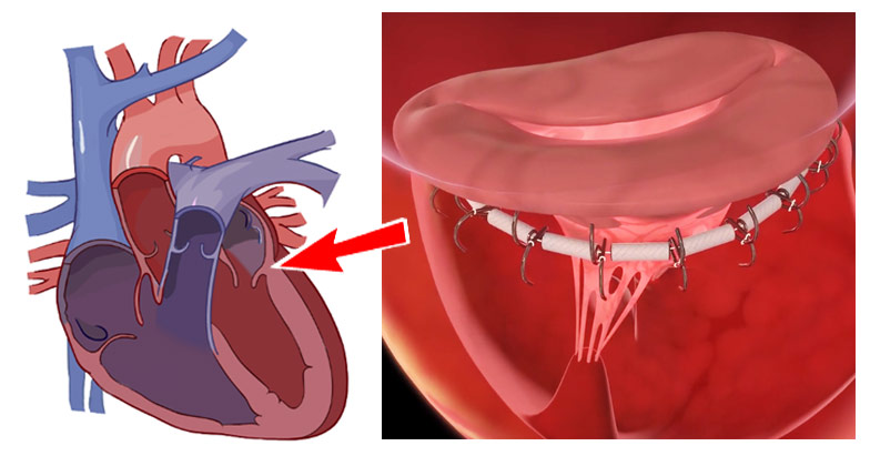 illustration of mitral valve device in clinical trial