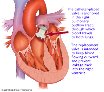 illustration of heart with displaying catheter-placed pulmonary valve