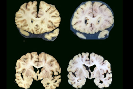 picture of brain slices denoting atrophy