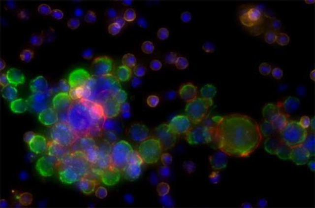 Immunofluorescent stains that bind cancer cell proteins color a cluster of circulating tumor cells.