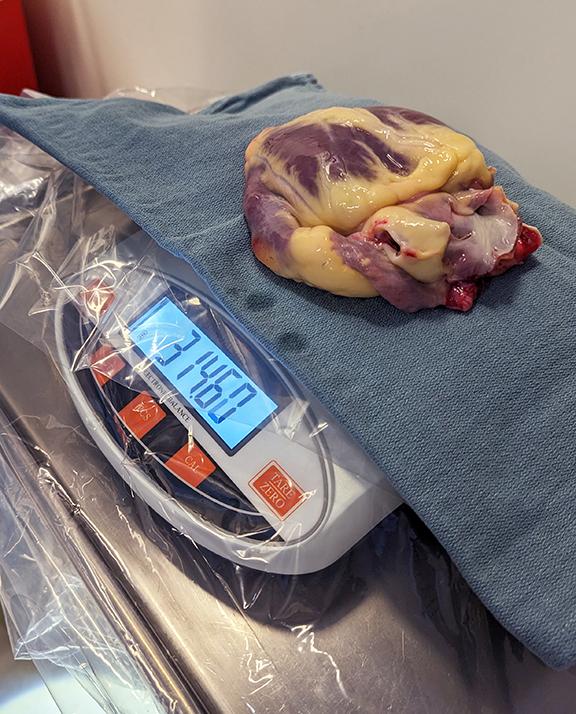 picture of donor heart being weighed before being transplanted into Adriana Rodriguez