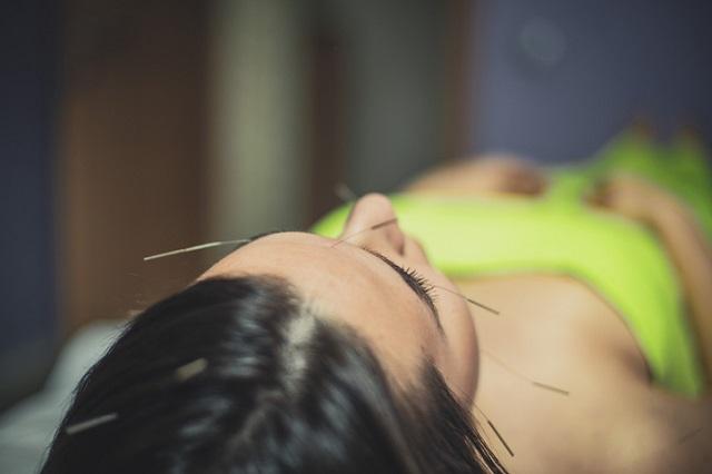 women getting acupuncture treatment