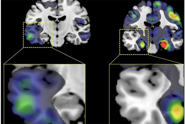 Alzheimer's MRI scan from study of different subtypes of the disease.