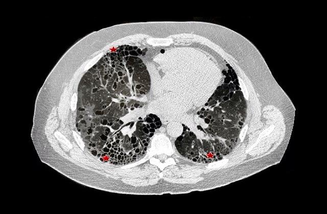 picture of CT scan of a patient's lung showing fibrotic scarring