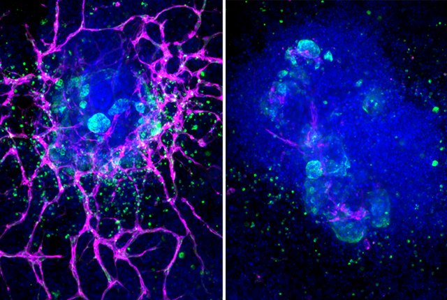healthy kidney organoid (left) extends a network of blood vessel cells (pink), but such cells disappear after treatment with interferon (right)