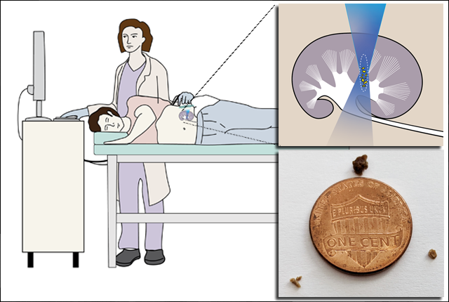 illustration of a patient receiving kidney-stone ultrasound and an image of kidney stones