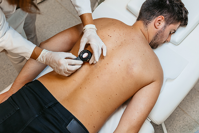 picture of clinician examining a mole for signs of cancer