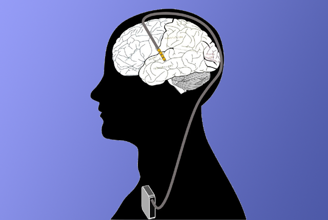 illustration of deep brain stimulation