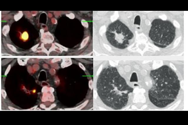 PET CT of Lung Cancer showing cancerous nodule