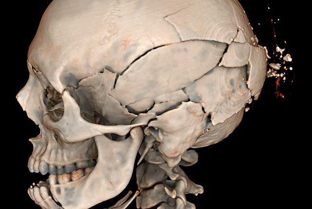 CT image of a person who sustained multiple skull fractures in a collision with an automobile