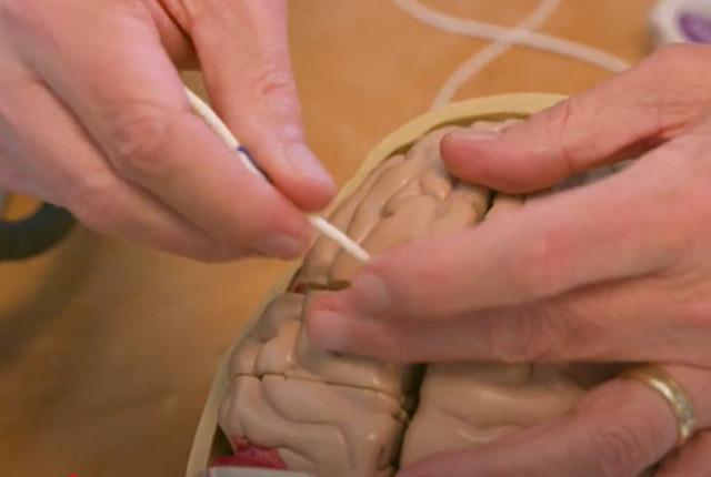 Demonstration on plastic model of shunt tube placement in the brain