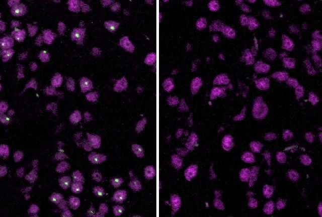 Left: Untreated brain cells carrying the Huntington's mutation show large protein aggregates (green). Right: In cells treated with ASO targeting huntingtin 1a, aggregates nearly vanished
