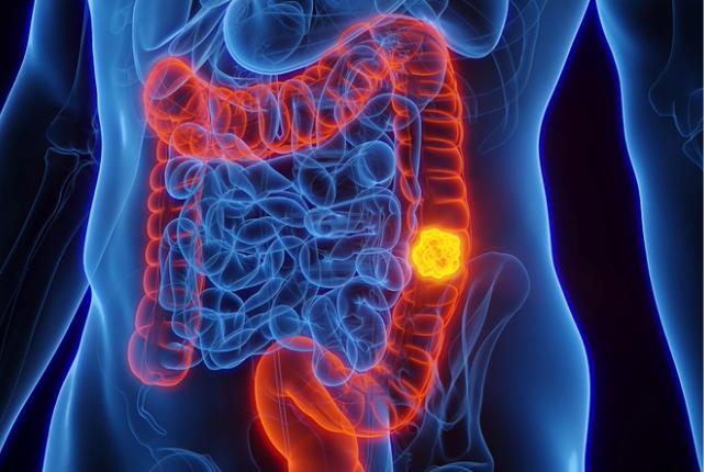 Illustration of colon cancer in a human body.