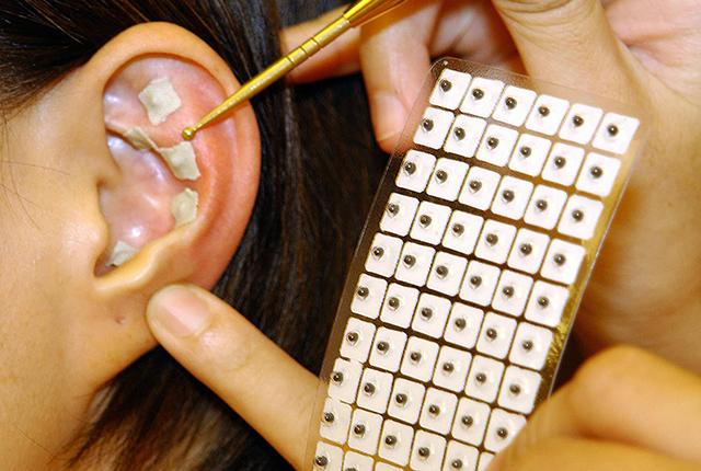 Tiny seeds, or metal versions of them, are taped onto specific acupressure points on an ear