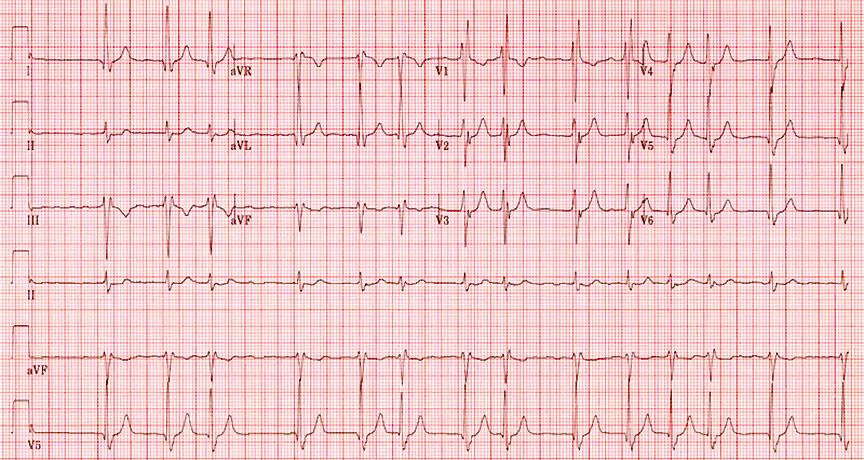 Media Name: a-fibrillation_ekg.jpg