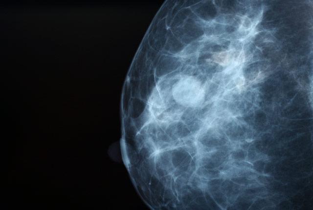 Media Name: ai-mammogram.jpg