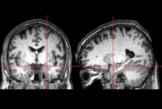 Media Name: amygdala-study-mri.png