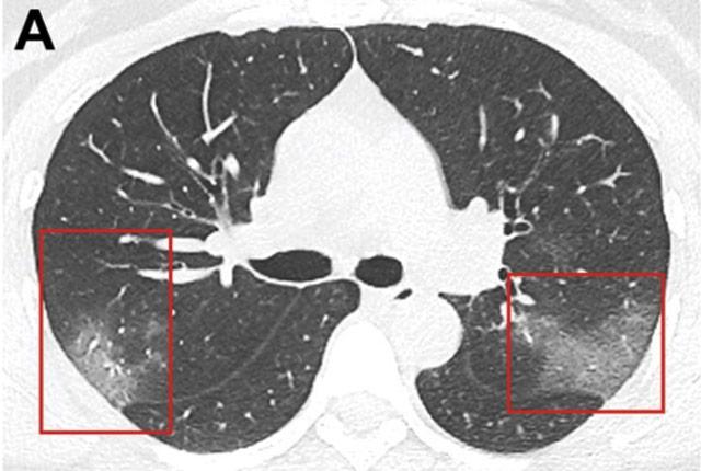 Media Name: covid_lungs-rsna.jpg