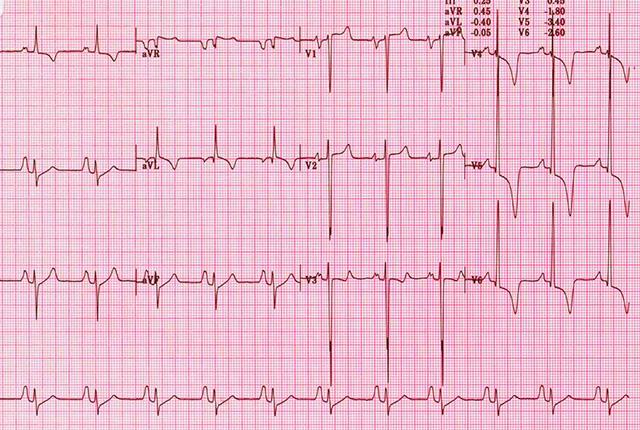 Media Name: ecg_-_abnormal.jpg