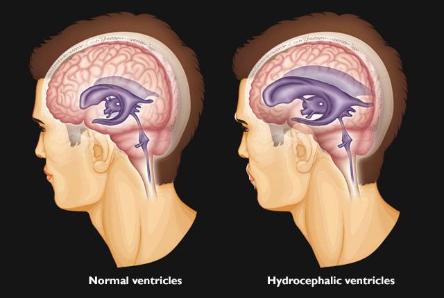 Media Name: hydrocephalus_illos.jpg