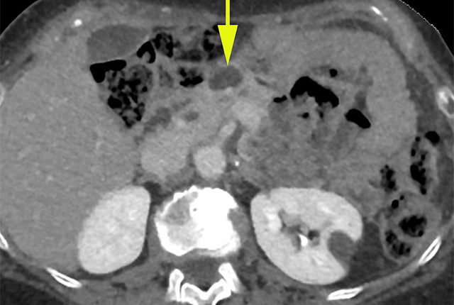 Media Name: incidental_pancreatic_cyst_ct.png