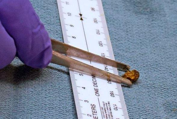 This is the image for Curious finding: Kidney stones rising among Millennials  entry