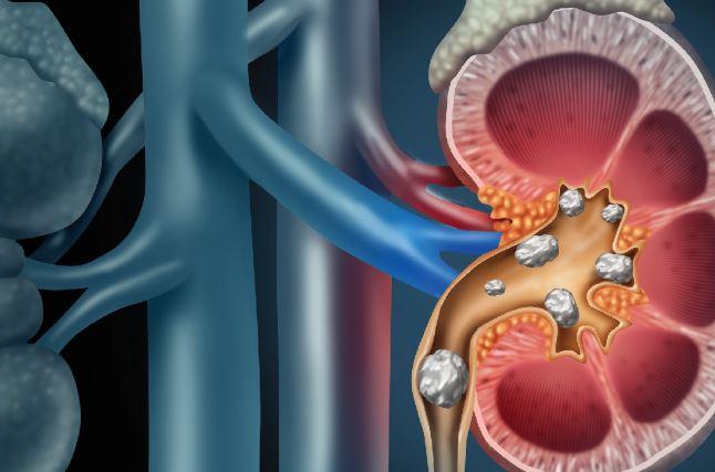 Media Name: kidneystonestents.jpg