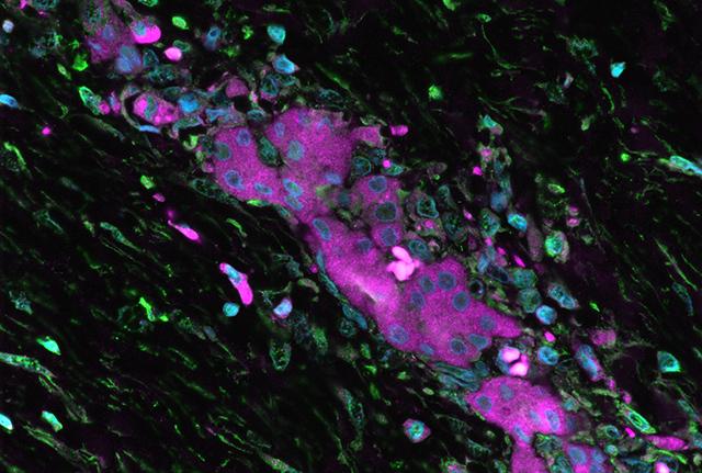 Media Name: liver_cancer_cells_flc_gerk_rperk_tumor_gr_pk.jpg