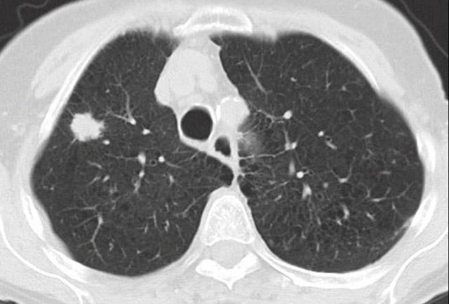 Media Name: lung_imaging_for_cancer_detection_farhood_crop.jpg