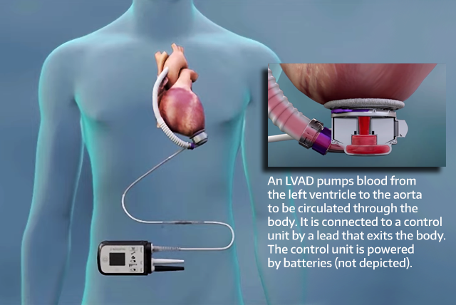 Media Name: lvad-main.png